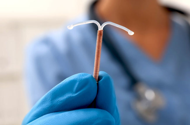 What you need to know about using a copper IUD as a birth control method